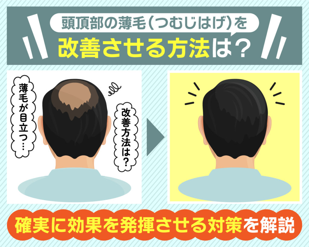 頭頂部の薄毛（つむじはげ）を改善させる方法は？確実に効果を発揮させる対策を解説