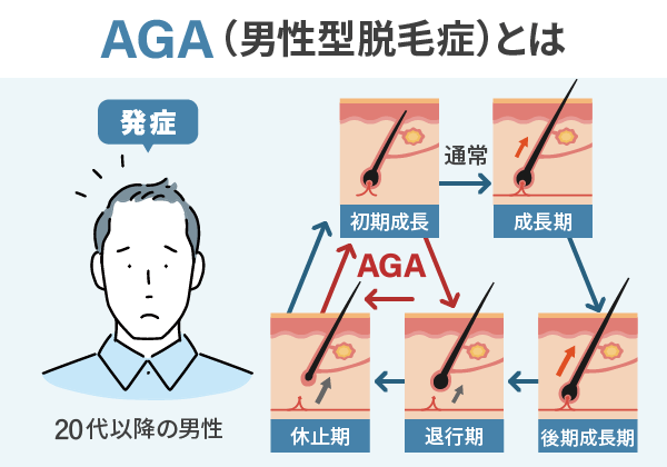 AGAを発症した人のメカニズムを表した図