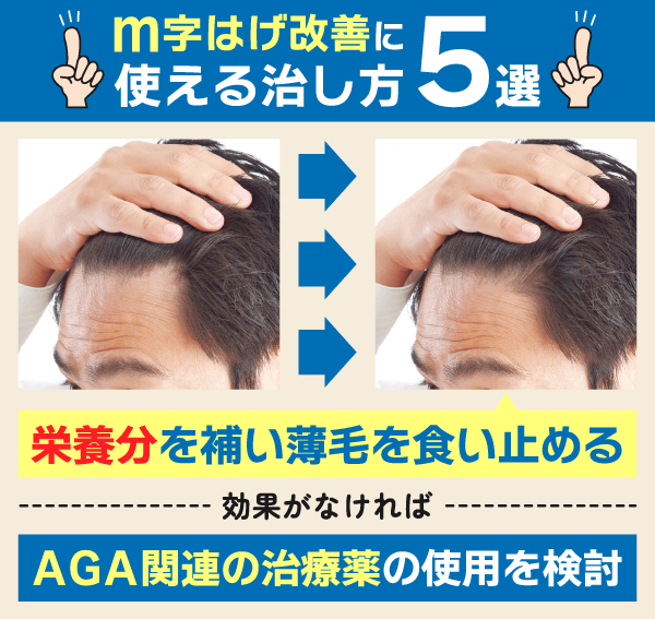 ｍ字はげ改善に使える治し方5選を紹介した図