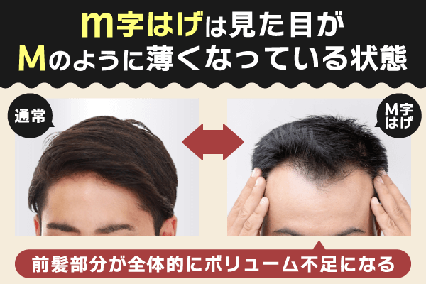 M字はげは見た目がMのように薄くなっている状態