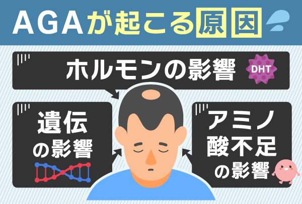 AGAが起こる3つの原因を紹介した図